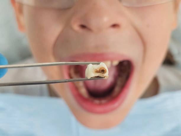 Best Emergency Gum Treatment in Happy Valley, OR