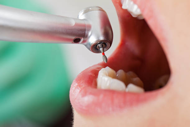 Best Urgent Care for Lost Fillings or Crowns in Happy Valley, OR